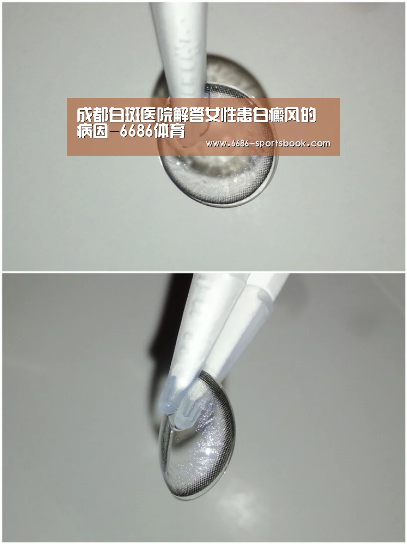 成都白斑医院解答女性患白癜风的病因-6686体育(图2) 6686比分